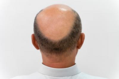 Rambut Tiba-Tiba Botak Membentuk Lingkaran? Hati-Hati Bisa Jadi Alopecia Areata –